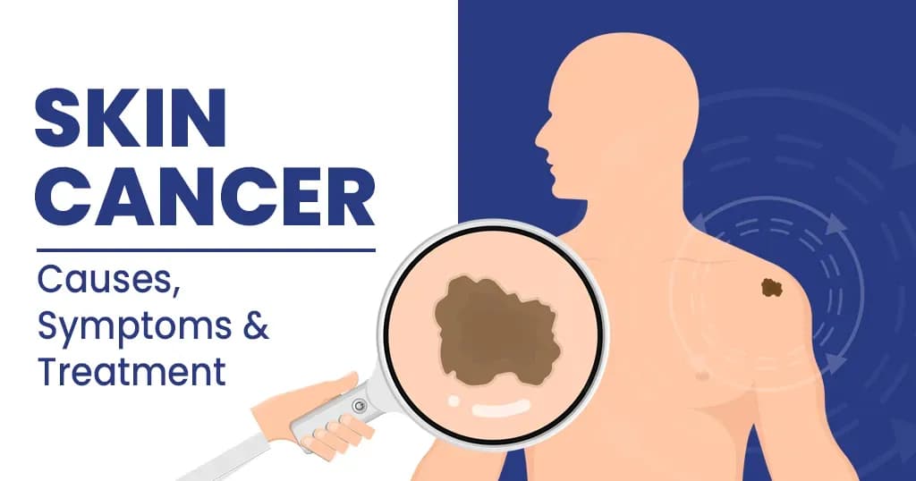 Skin cancer - Causes, symptoms and treatment