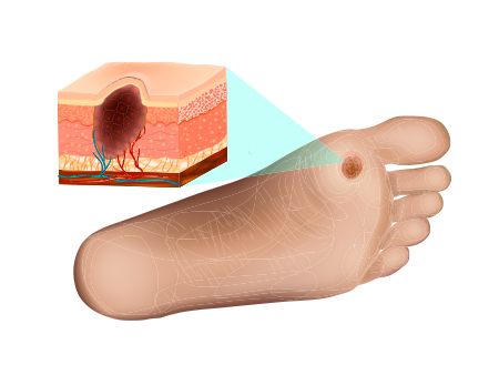 Foot Problems due to diabetes