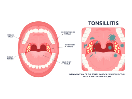 Tonsil stones